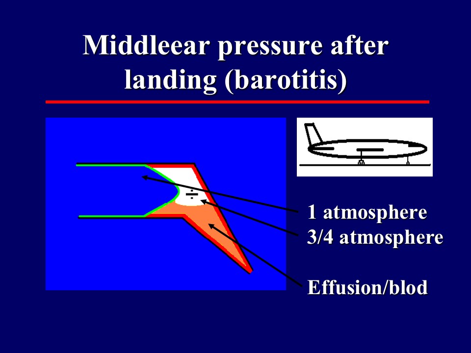 Middleear pressure after landing (barotitis)