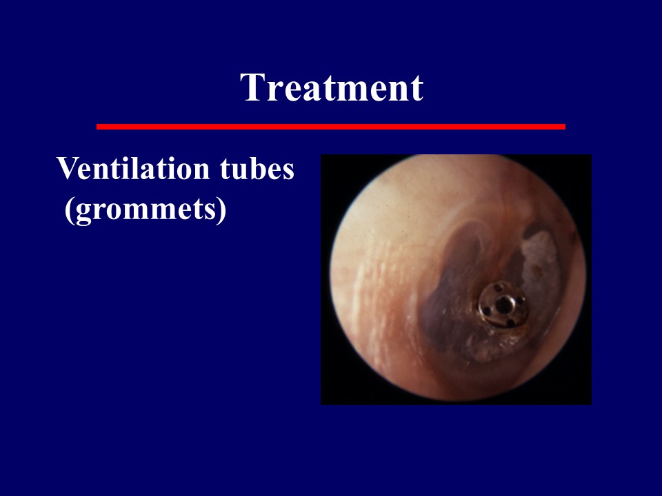 Ventilation tubes