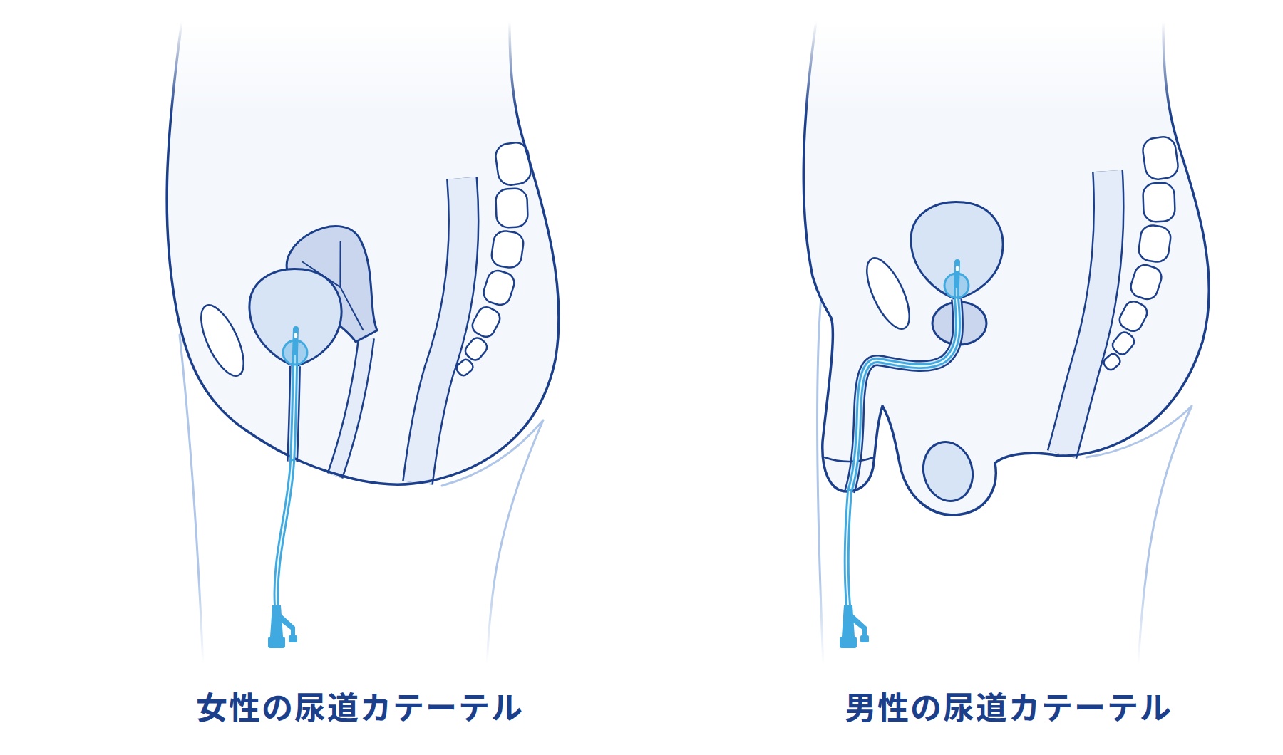 尿道カテーテル解説イラスト(女性・男性)